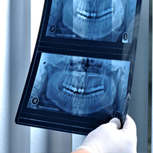 Teeth X-Rays - Rob's Denture Studio